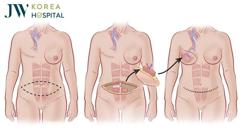Nâng ngực bằng phương pháp chuyển vạt cơ bụng tại bệnh viện JW 
