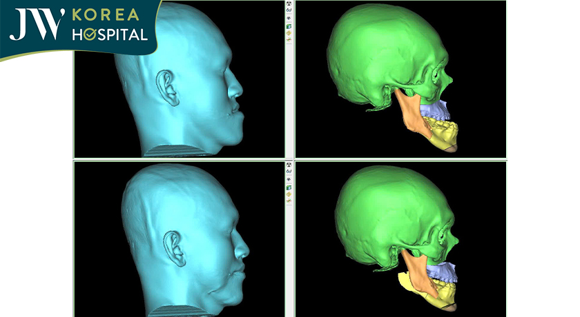 Công nghệ 3D hỗ trợ mô phỏng phẫu thuật, xác định chính xác vị trí cắt và di chuyển hàm