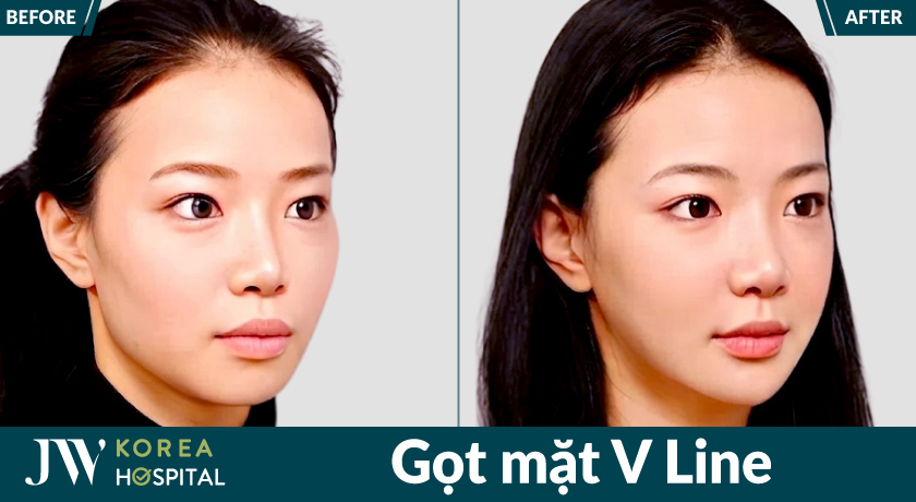 Gọt mặt V Line tại bệnh viện JW giúp cải thiện góc hàm và tỷ lệ khuôn mặt cân đối