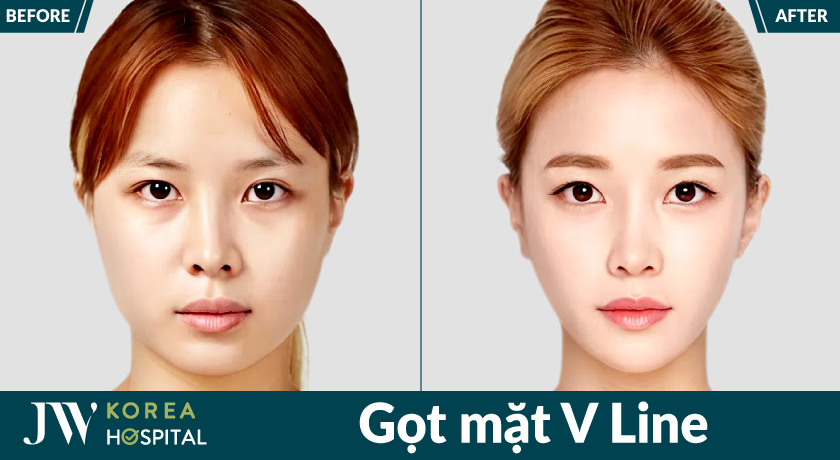 Phẫu thuật gọt mặt V Line giúp giảm góc hàm thô và cải thiện dáng mặt