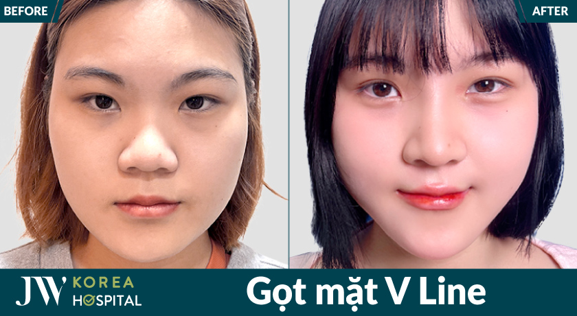 Gọt mặt V Line tại JW mang lại gương mặt thanh thoát và tự nhiên hơn