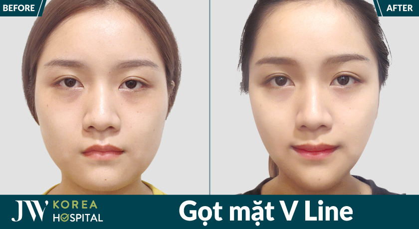 Gọt mặt V Line giúp cải thiện đường nét khuôn mặt cân đối và mềm mại