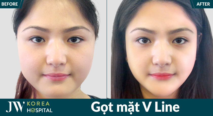 Gọt mặt V Line tại Bệnh viện JW giúp gương mặt thon gọn, hài hòa hơn