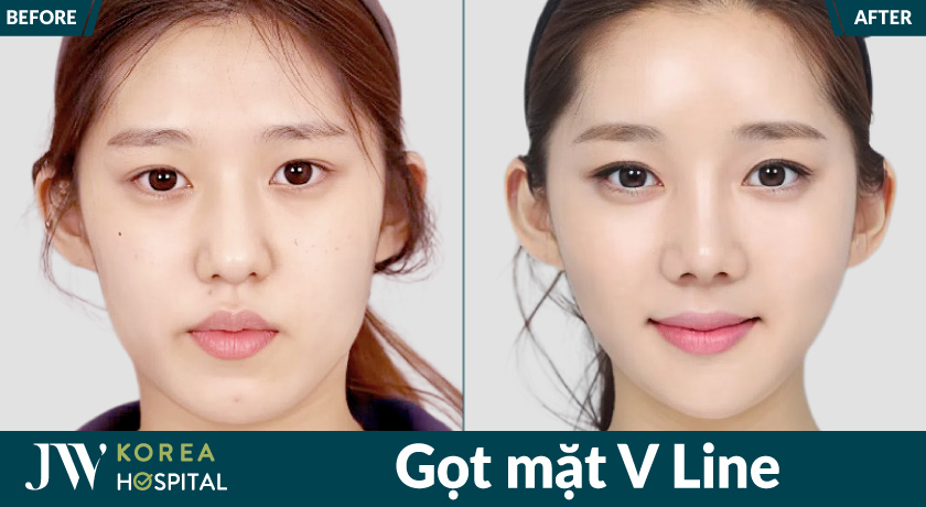 Phẫu thuật gọt mặt V Line tại Bệnh viện JW giúp gương mặt nhỏ gọn và hài hòa hơn