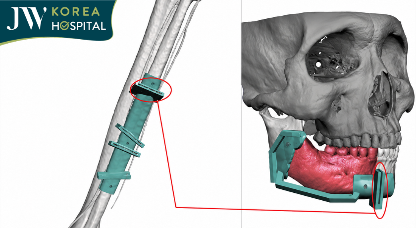 Máng phẫu thuật 3D cũng được thiết kế riêng cho bệnh nhân nhằm hỗ trợ định vị xương hàm chính xác