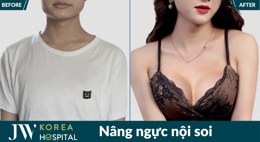 Hình ảnh khách hàng trước và sau nâng ngực nội soi tại JW