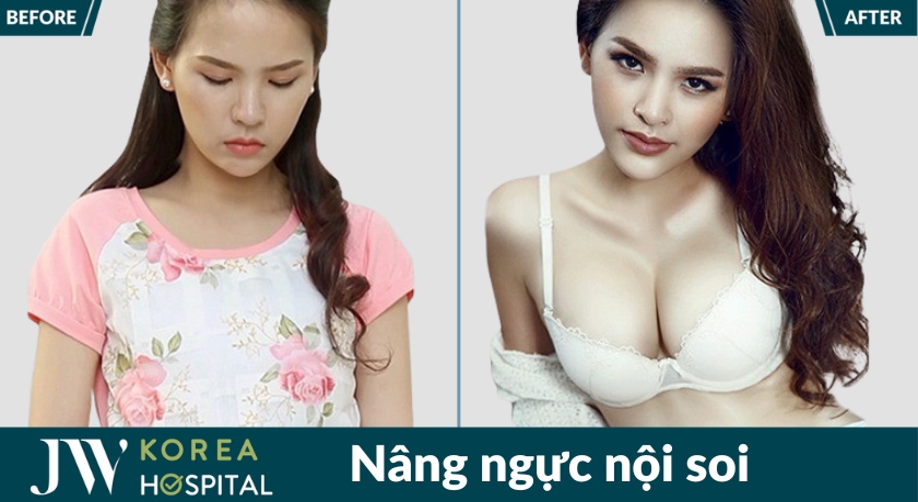 Nâng ngực nội soi tại Bệnh viện JW giúp sở hữu vòng 1 căng tròn quyến rũ tự nhiên