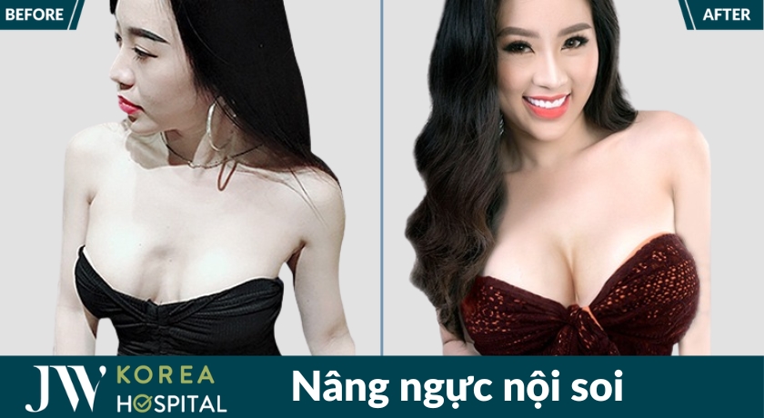 Hình ảnh trước và sau nâng ngực nội soi của khách hàng tại bệnh viện JW