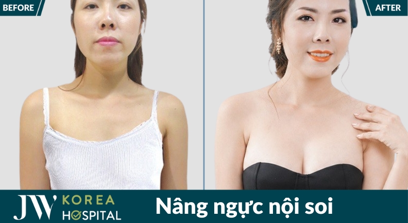 Sở hữu vòng 1 quyến rũ, gợi cảm sau nâng ngực nội soi tại JW