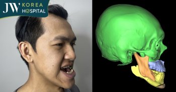 Phẫu thuật ảo 3D: Vì sao ca phẫu thuật hàm mặt của Soda phải “mổ thử” trước trên phần mềm?