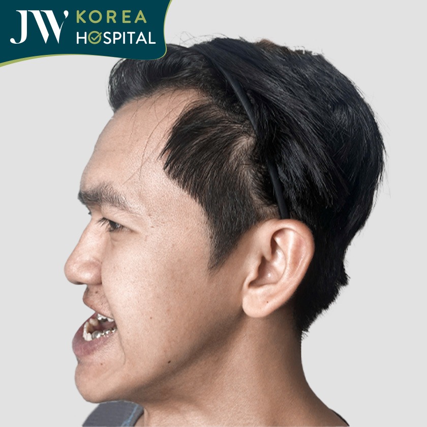 Nhiếp ảnh gia Gen Z người Campuchia vượt biên đến Việt Nam để phẫu thuật hàm 2 lần tại JW