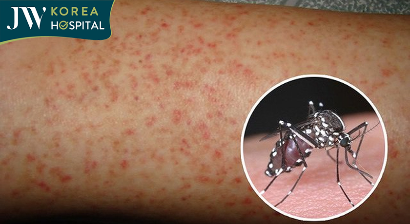 sốt xuất huyết dengue vô cùng phổ biến tại Việt Nam