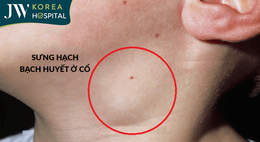 Sưng hạch bạch huyết là triệu chứng dấu hiệu ung thư máu