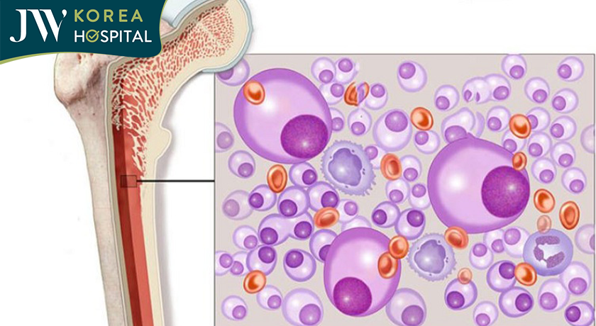 Đa u tủy xương (Multiple Myeloma)