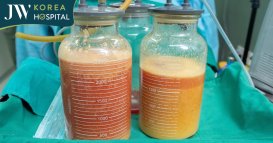 5 lít dịch và chất lạ được lấy ra từ ngực của người phụ nữ tiêm mỡ nhân tạo sau 20 năm