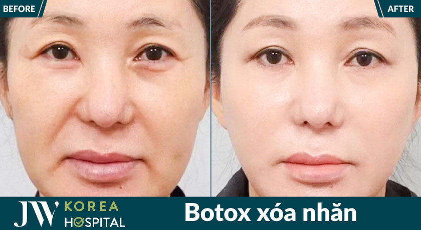 Xóa nếp nhăn li ti vùng mắt, nếp nhăn trán, vết chân chim với botox chuẩn Hàn tại Bệnh viện JW