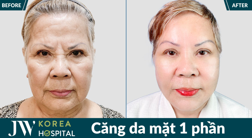 Căng da mặt 1 phần giúp xóa nếp nhăn, trả lại vẻ tươi trẻ