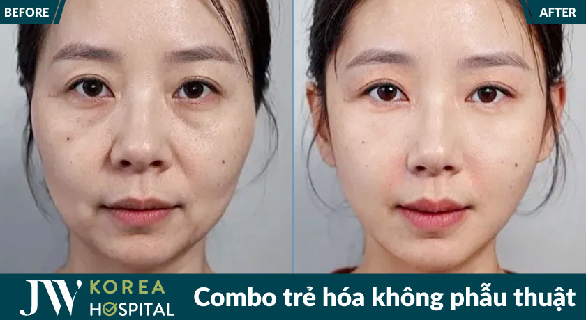 Khắc phục mọi khuyết điểm, tái sinh nhan sắc với Combo trẻ hóa không phẫu thuật tại bệnh viện JW