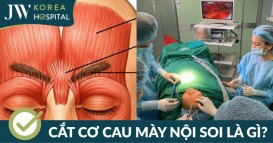 Cắt cơ cau mày là gì? Địa chỉ cắt cơ cau mày uy tín ở TP.HCM