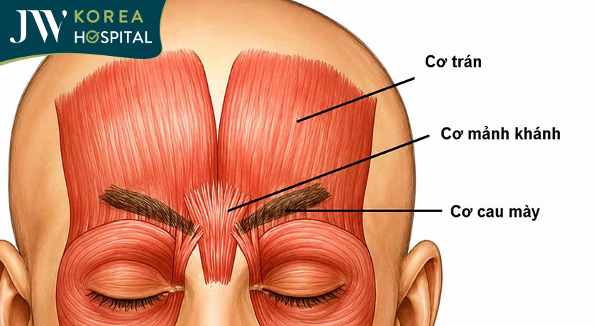 Cắt cơ cau mày xóa rãnh cau mày trẻ 10 tuổi tại bệnh viện JW
