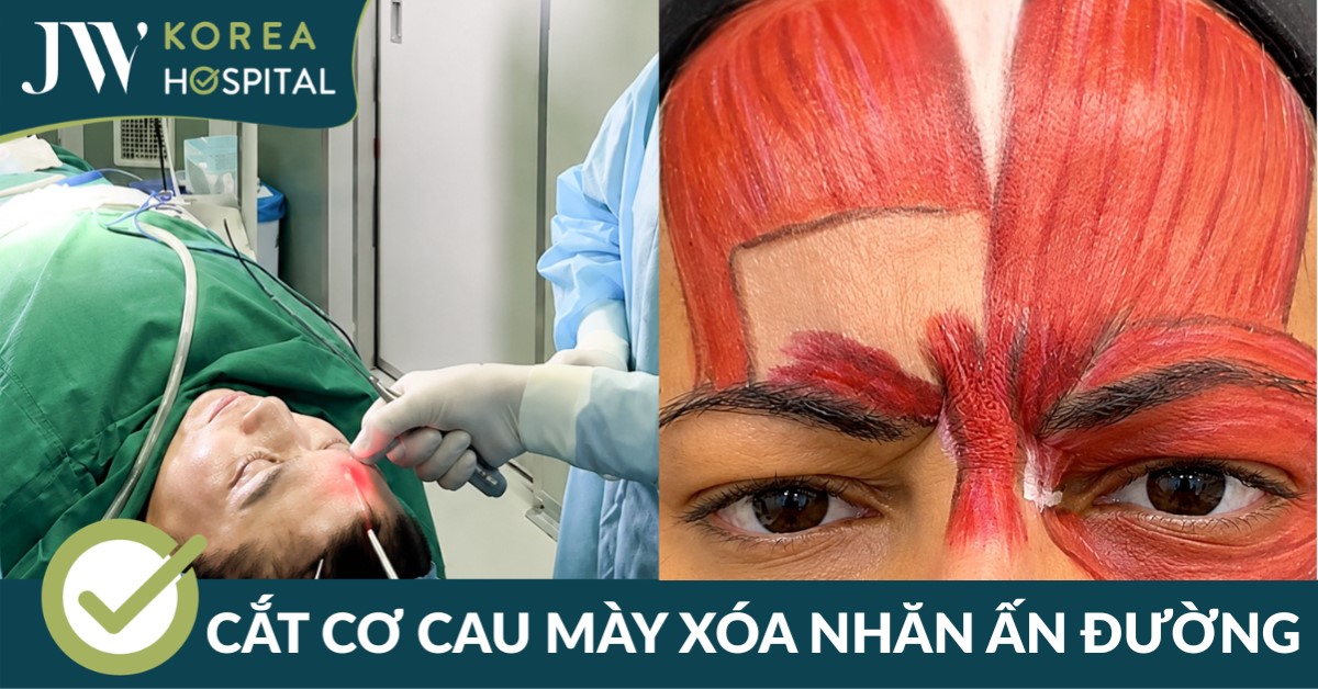 Cắt cơ cau mày: Cơ chế điều trị tận gốc nếp nhăn vùng ấn đường theo góc nhìn y khoa