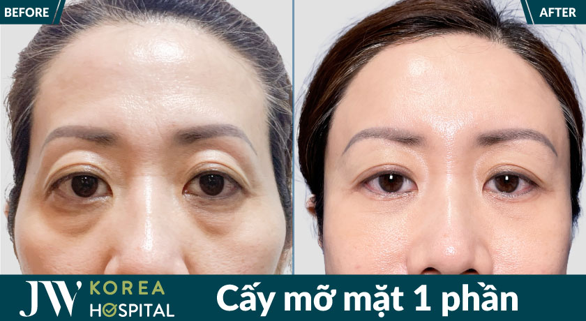 Cấy mỡ mặt 1 phần tại Bệnh viện JW giúp cải thiện má hóp, thiếu sức sống