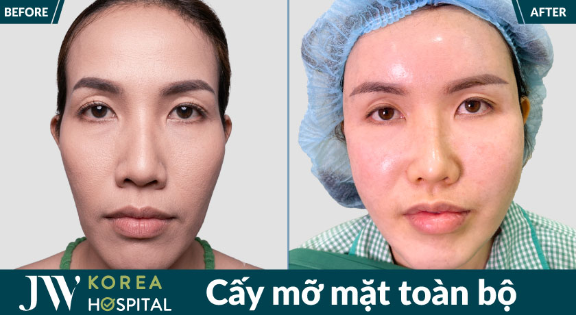 Kết quả trước và sau cấy mỡ mặt toàn bộ của khách hàng tại Bệnh viện JW
