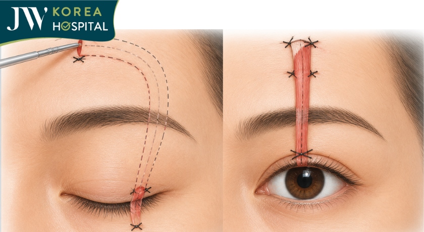 Kỹ thuật chuyển vạt cơ trán điều trị sụp mi