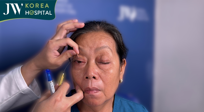 Điều trị sụp mi tại Bệnh viện JW giúp cải thiện tầm nhìn và chức năng nâng mi
