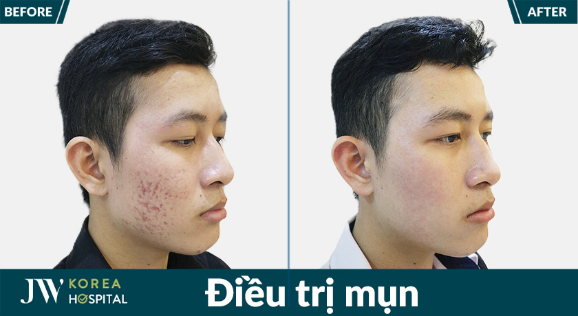 Hình ảnh trước và sau điều trị mụn tại bệnh viện JW