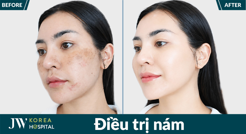 Hình ảnh trước và sau điều trị nám tại bệnh viện JW