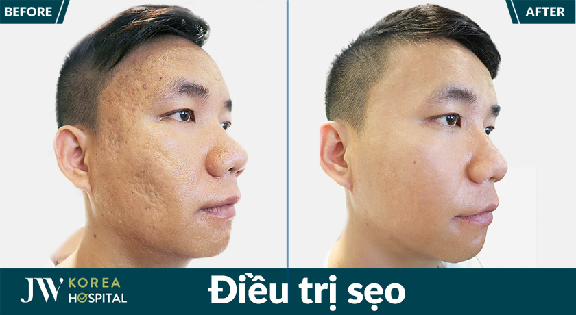 Hình ảnh trước và sau điều trị sẹo tại bệnh viện JW