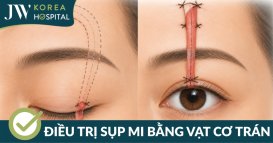Điều trị sụp mi bằng phương pháp chuyển vạt cơ trán tại Bệnh viện JW Hàn Quốc