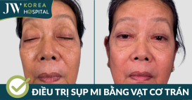 Điều trị sụp mi bằng vạt cơ trán tại bệnh viện JW