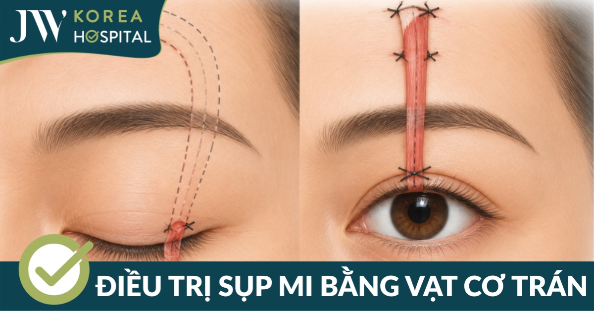 Điều trị sụp mi bằng vạt cơ trán: Giải pháp hiệu quả cho sụp mi bẩm sinh và sụp mi nặng