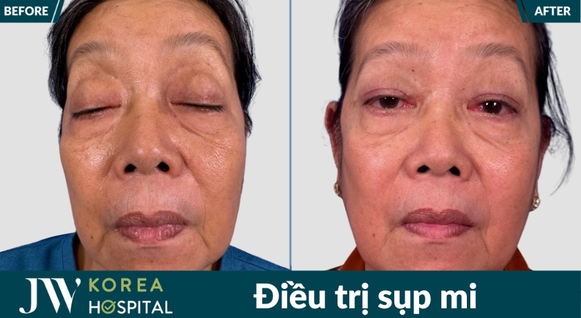 Kết quả của bệnh nhân sau khi điều trị sụp mi tại bệnh viện JW