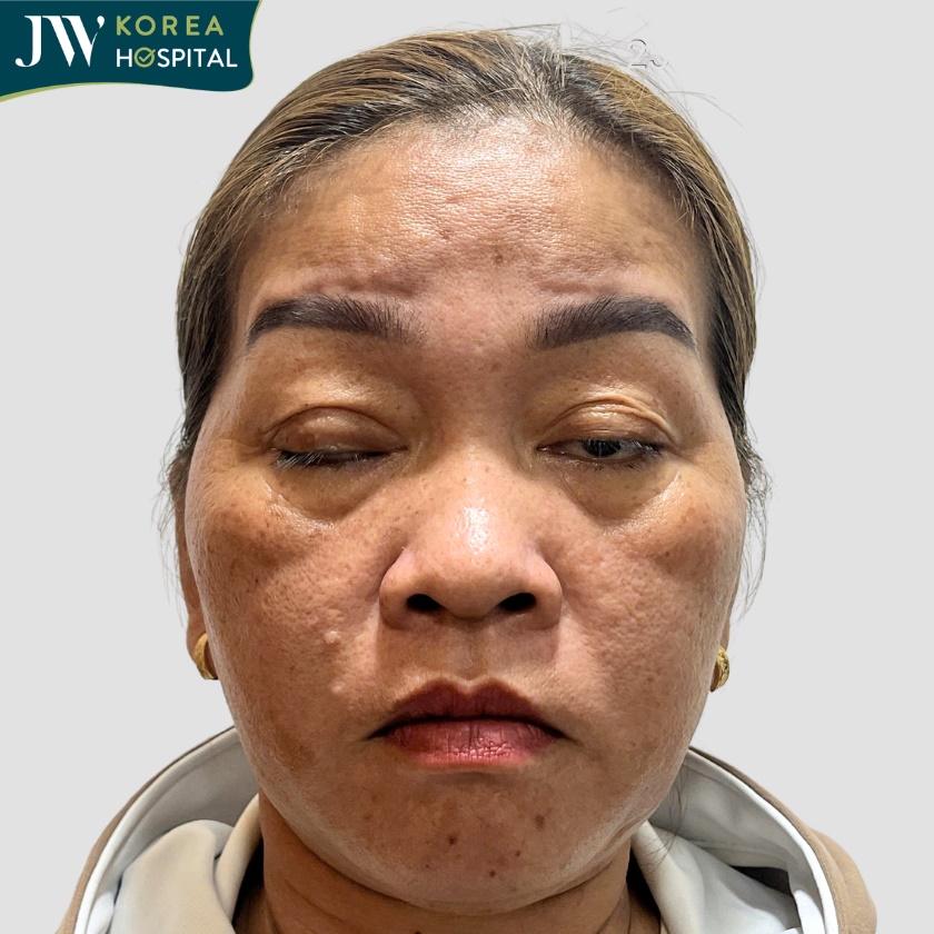 Điều trị sụp mi tại Bệnh viện JW góp phần cải thiện chức năng mở mắt và thẩm mỹ cho bệnh nhân