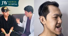 Hình ảnh mới nhất của Soda Camp sau phẫu thuật hàm móm tại Bệnh viện JW