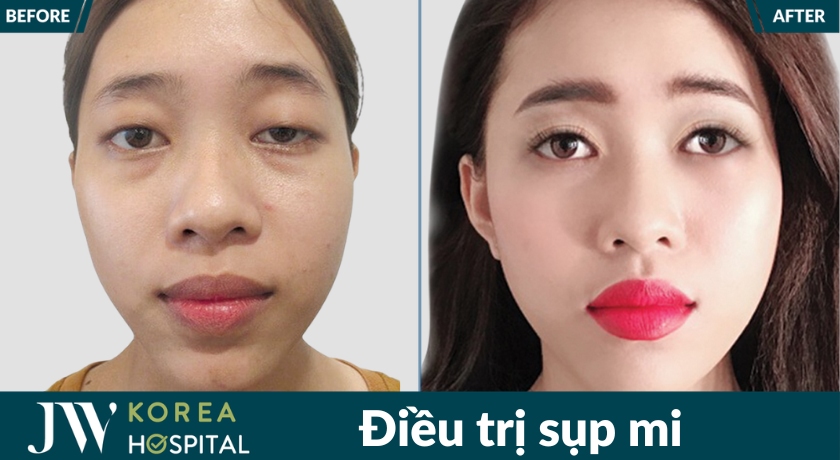 Hình ảnh trước và sau điều trị sụp mí tại Bệnh viện JW