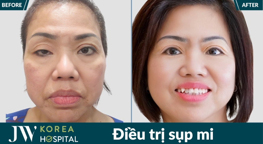 Điều trị sụp mi tại Bệnh viện JW giúp cải thiện tầm nhìn, khôi phục chức năng nâng mi và mang lại đôi mắt cân đối tự nhiên