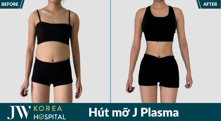 Hình ảnh trước và sau hút mỡ J Plasma tại Bệnh viện JW