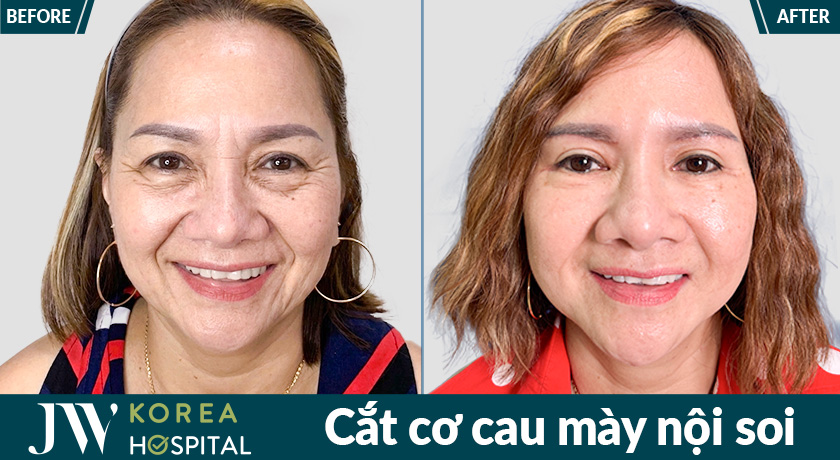 Kết quả trước và sau cắt cơ cau mày nội soi tại bệnh viện JW