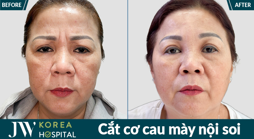 Kết quả cắt cơ cau mày nội soi tại Bệnh viện JW giúp giảm tình trạng cau mày khi biểu cảm