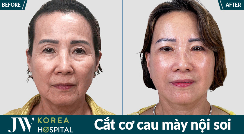 Hình ảnh khách hàng sau cắt cơ cau mày nội soi tại Bệnh viện JW với gương mặt trẻ trung và thư thái hơn