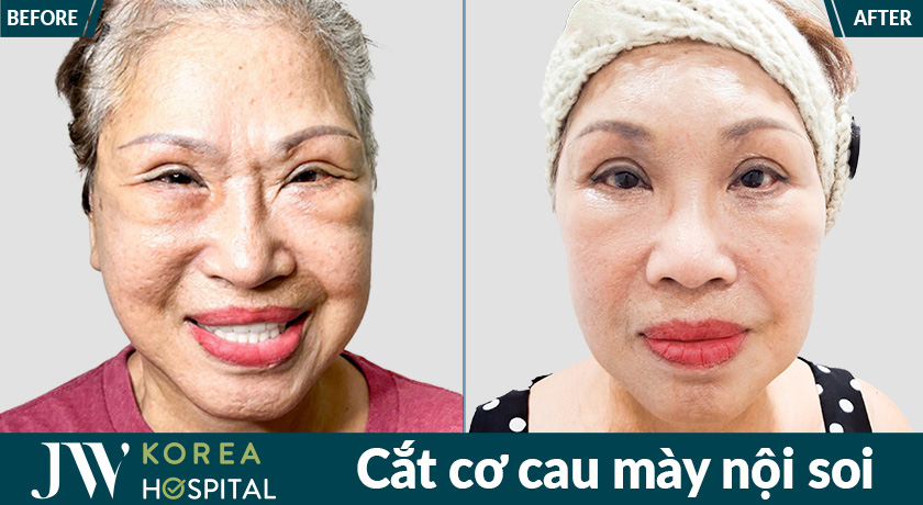 Kết quả trước và sau cắt cơ cau mày nội soi tại Bệnh viện JW giúp xóa rõ nếp nhăn giữa hai chân mày