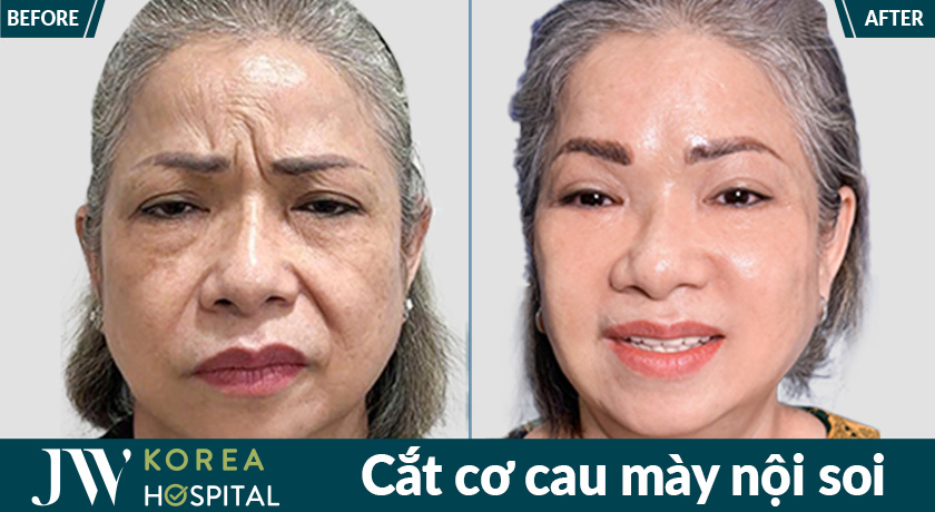 99% khách hàng hài lòng với kết quả cắt cơ cau mày nội soi tại Bệnh viện JW