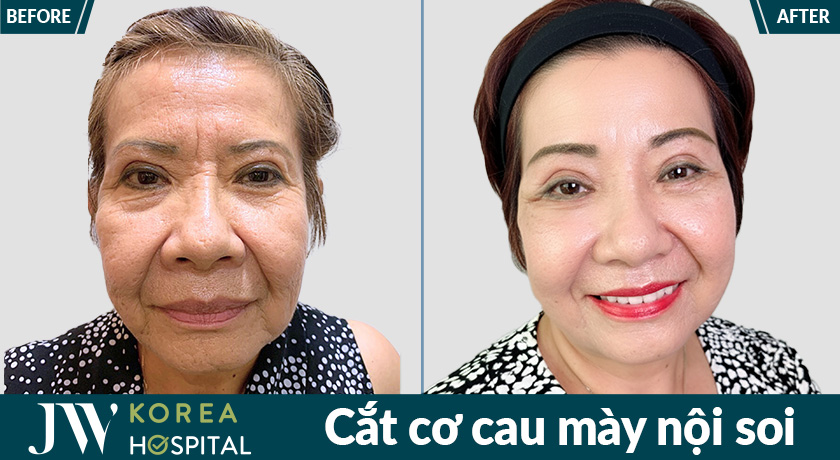 Cắt cơ cau mày nội soi tại Bệnh viện JW mang lại hiệu quả trẻ hóa vùng trán mà không làm thay đổi biểu cảm tự nhiên
