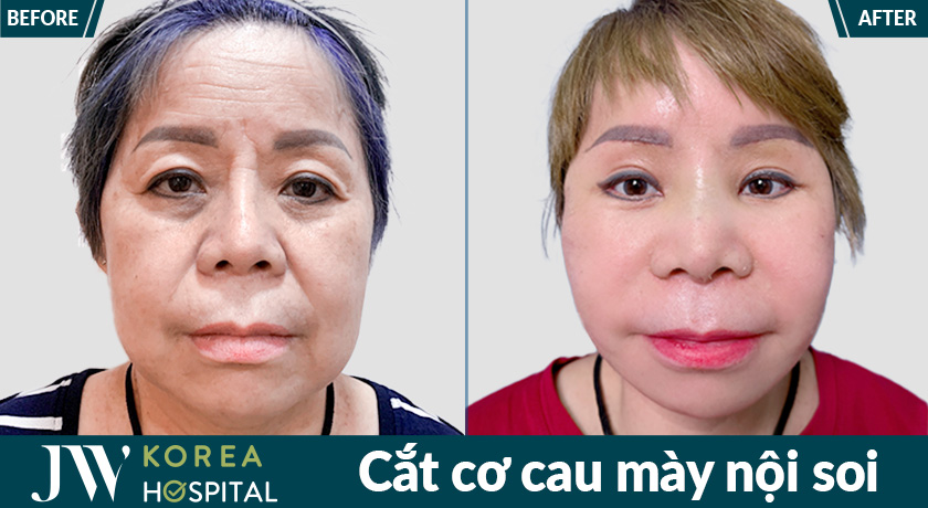 Gương mặt khách hàng trở nên nhẹ nhàng, giảm vẻ cau có sau cắt cơ cau mày nội soi tại Bệnh viện JW