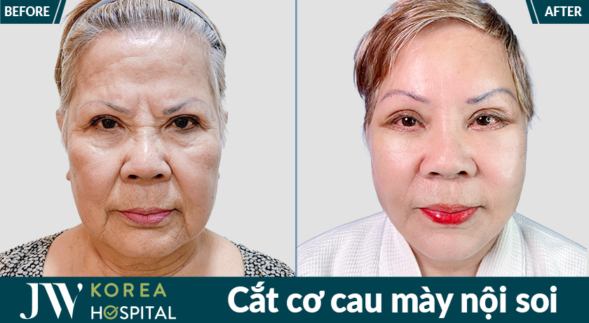 Kết quả cắt cơ cau mày nội soi tại Bệnh viện JW giúp cải thiện nếp nhăn động và tạo vẻ ngoài trẻ trung hơn