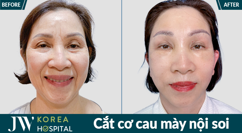 Kết quả cắt cơ cau mày nội soi tại Bệnh viện JW mang lại vùng giữa hai chân mày phẳng mịn và tự nhiên